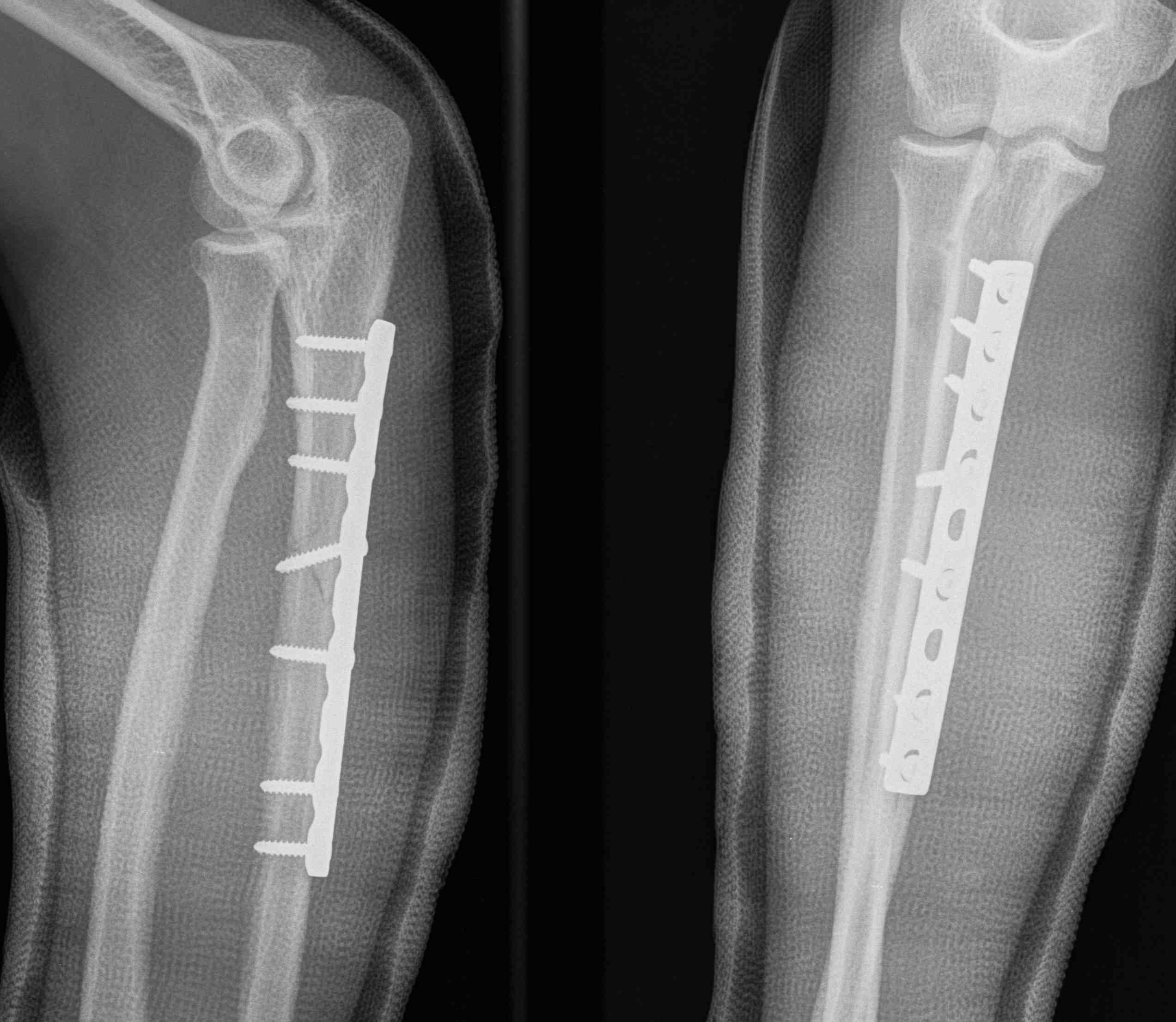 Ulna Plating